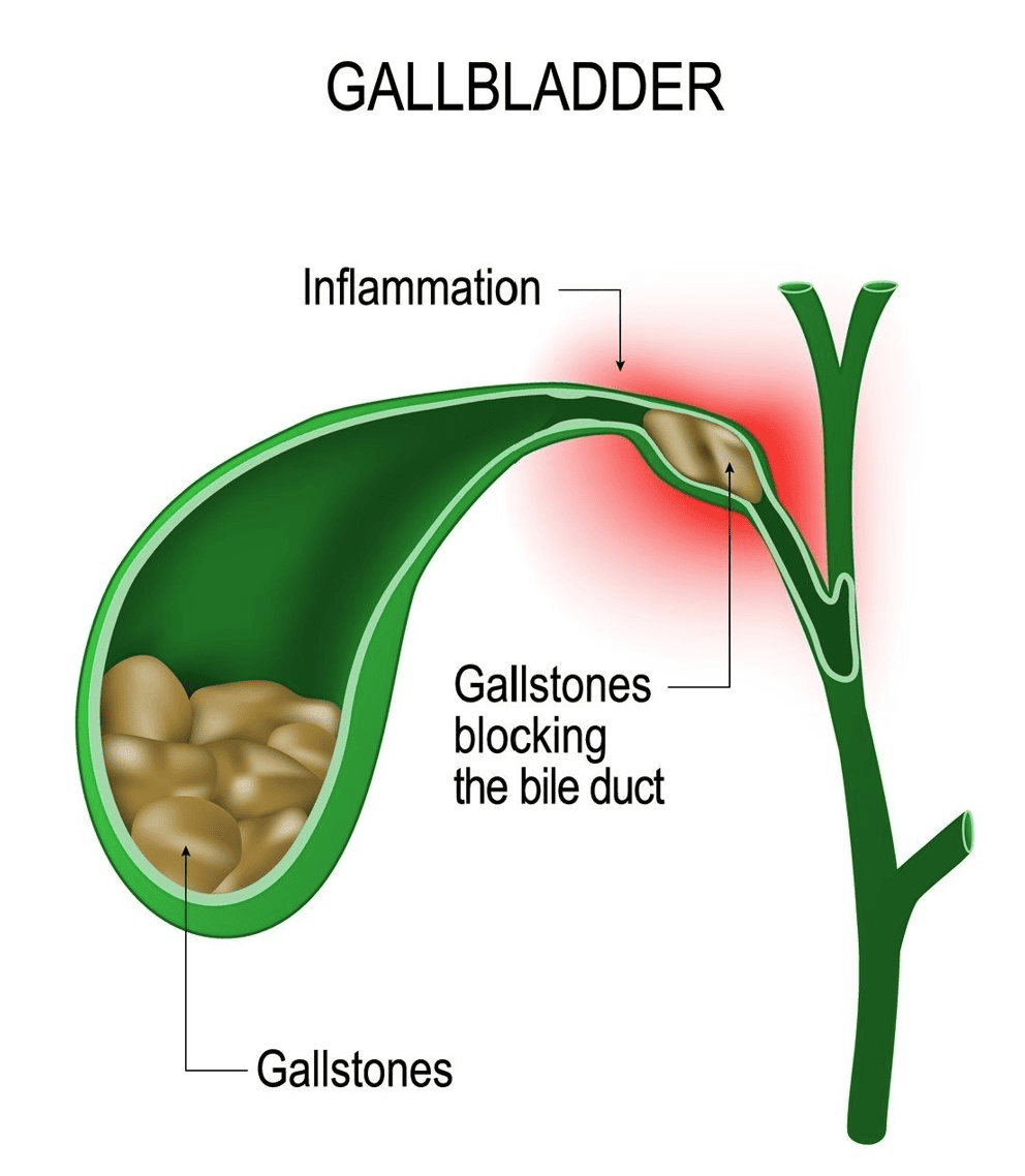 Ozempic Lawsuit for Gastroparesis | Saiontz & Kirk, P.A.